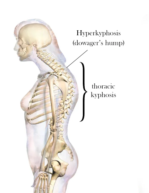 Dowager's Hump - Causes, Symptoms, Treatment - Samarpan
